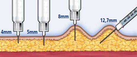 terapia-diabete-tipo-1-insulina-sedi-iniezione.jpg